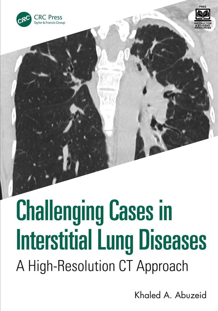 Challenging Cases in Interstitial Lung Diseases
