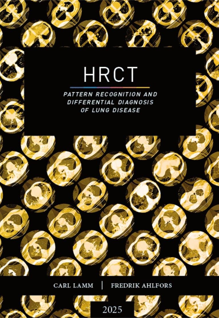 HRCT : pattern recognition and differential diagnosis of lung disease