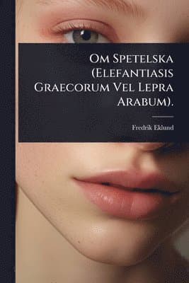 Om Spetelska (Elefantiasis Graecorum Vel Lepra Arabum).
